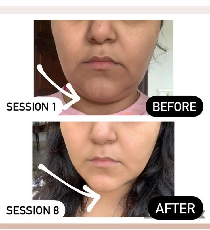 Face Yoga client transformation 2
